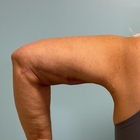 After image 3 Case #129191 - 58 y.o. female with Brachioplasty and Liposuction
