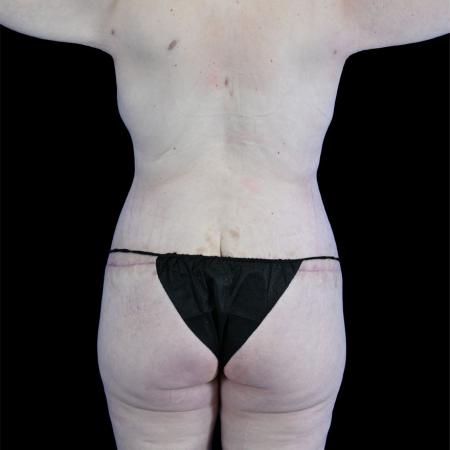 After image 4 Case #129156 - High-Definition Lower Body Lift