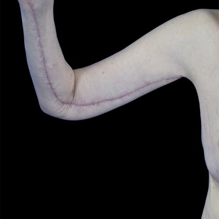 After image 1 Case #129146 - Arm lift with forearm reduction