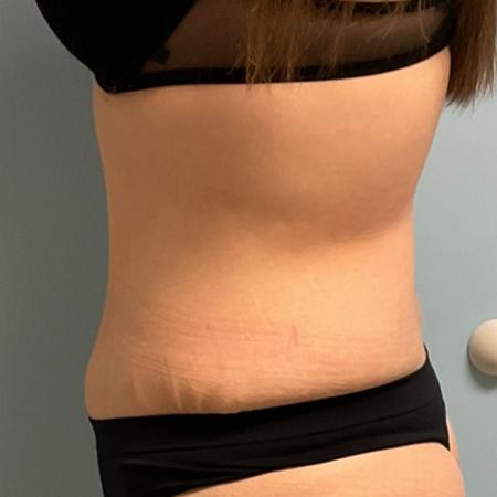 After Case #129056 - 33 y.o. female w/ Tummy Tuck, Lipo and BBL