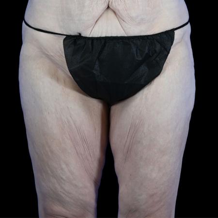 Before image 1 Case #129151 - Thighplasty