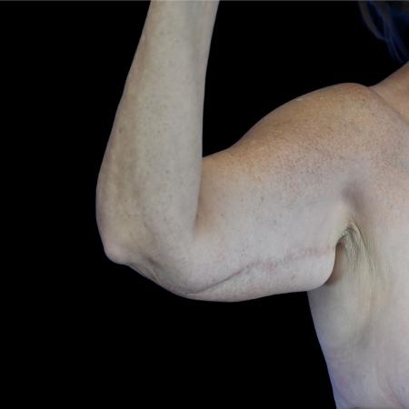 Before image 2 Case #129131 - Revision arm lift (brachioplasty)
