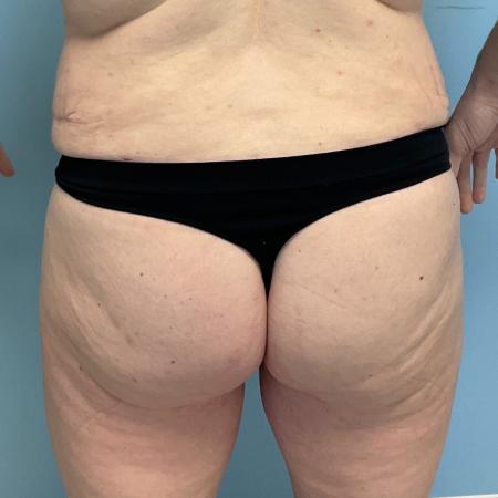 After image 2 Case #129256 - 38 y.o. with BBL through Fat Transfer