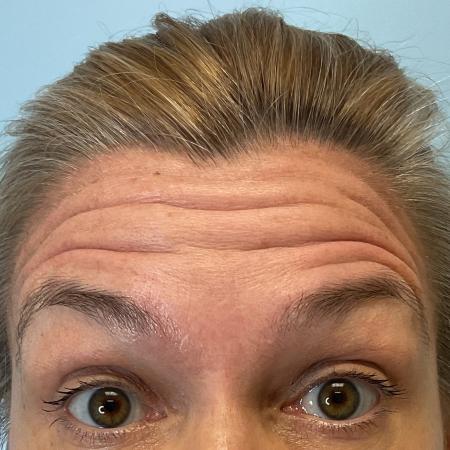 Before image 1 Case #129801 - 47 y.o. female with Botox