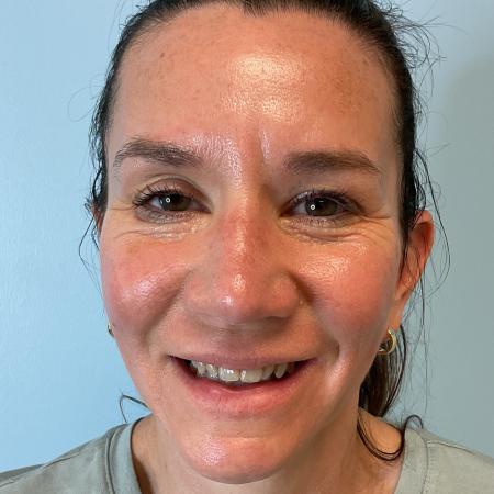 After image 3 Case #129796 - 45 y.o. female with Botox