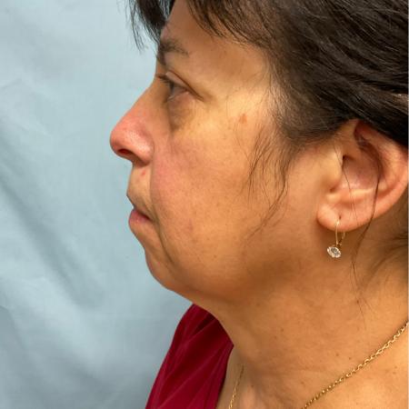 Before image 1 Case #129811 - 66 y.o female with Face & Necklift w/ Fat Grafting