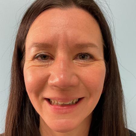 Before image 3 Case #129796 - 45 y.o. female with Botox