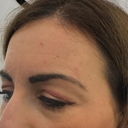 Before image 3 Case #130021 - upper blepharoplasty