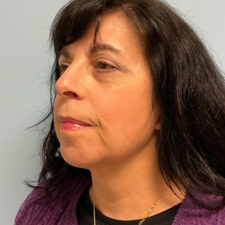 After image 2 Case #129811 - 66 y.o female with Face & Necklift w/ Fat Grafting