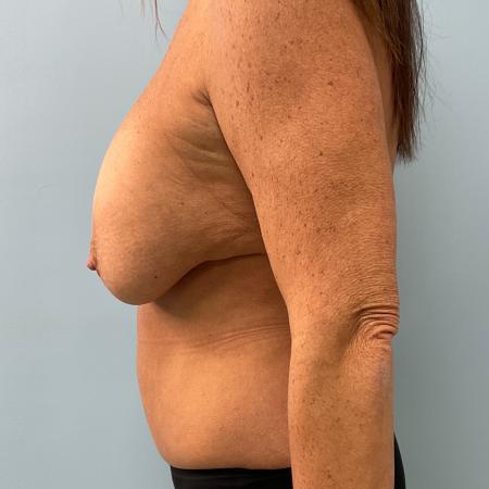 Before image 3 Case #129681 - 55 y.o female with Mommy Makeover