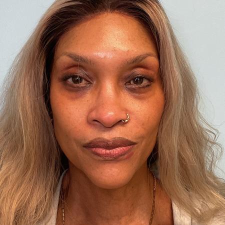 After image 1 Case #129906 - 54 y.o. female w/ Lower Blepharoplasty