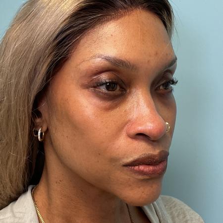 After image 3 Case #129906 - 54 y.o. female w/ Lower Blepharoplasty