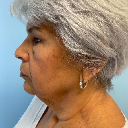 Before image 3 Case #129511 - 75 y.o. female w/ Face & Neck Lift