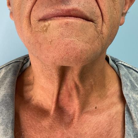 Before image 3 Case #129916 - 64 y.o. male with Face and Necklift