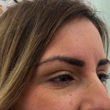 After image 2 Case #130021 - upper blepharoplasty