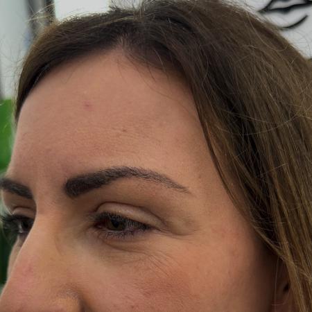 After image 3 Case #130021 - upper blepharoplasty