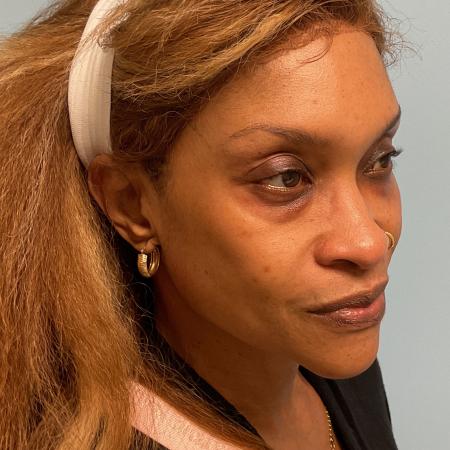 Before image 3 Case #129906 - 54 y.o. female w/ Lower Blepharoplasty