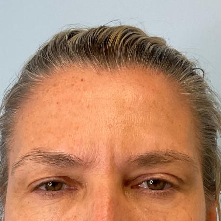 After image 2 Case #129801 - 47 y.o. female with Botox