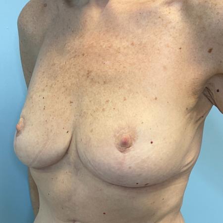 After image 2 Case #129836 - 67 y.o. female with Breast Lift