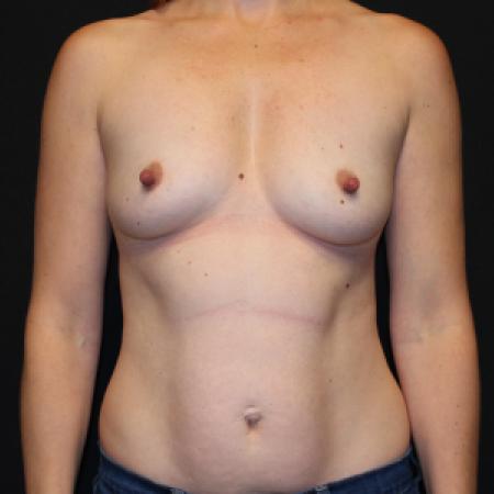 Before image 1 Case #129936 - Breast augmentation