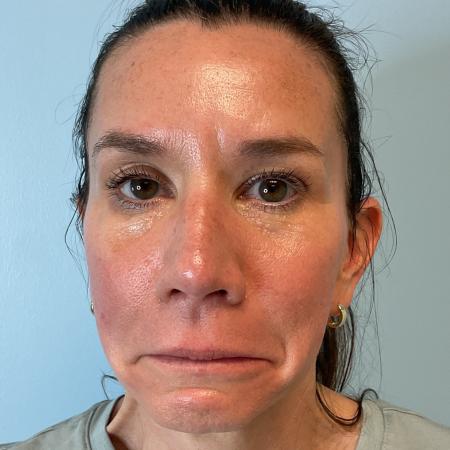 After image 1 Case #129796 - 45 y.o. female with Botox