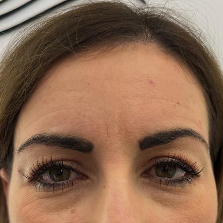 Before image 1 Case #130021 - upper blepharoplasty