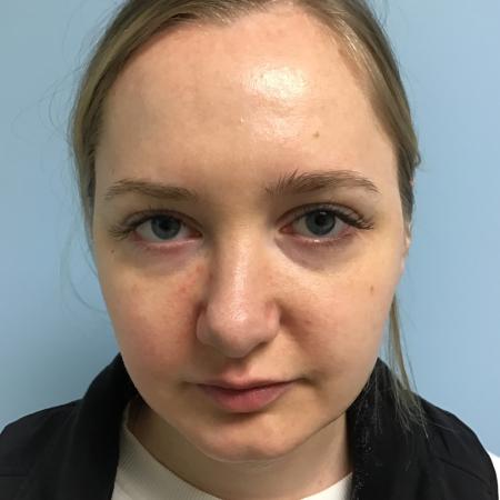 Before image 1 Case #129531 - 32 y.o. female with Filler and Botox Injections 