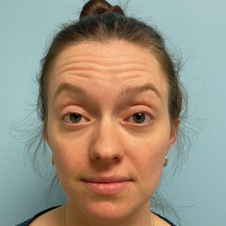 Before image 1 Case #129551 - 31 y.o. female with Botox and Lip Filler