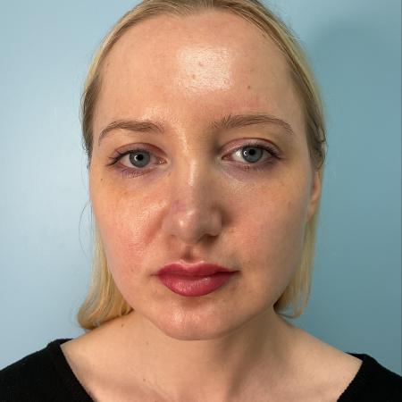 After image 1 Case #129531 - 32 y.o. female with Filler and Botox Injections 