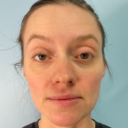 After image 1 Case #129551 - 31 y.o. female with Botox and Lip Filler