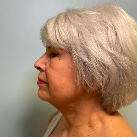 After image 3 Case #129511 - 75 y.o. female w/ Face & Neck Lift