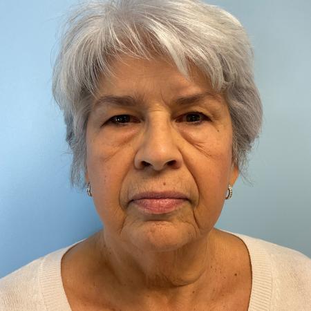 Before image 1 Case #129511 - 75 y.o. female w/ Face & Neck Lift