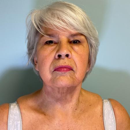 After image 1 Case #129511 - 75 y.o. female w/ Face & Neck Lift