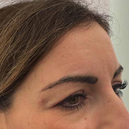 Before image 2 Case #130021 - upper blepharoplasty