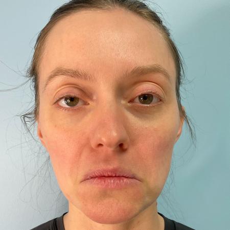 After image 2 Case #129551 - 31 y.o. female with Botox and Lip Filler