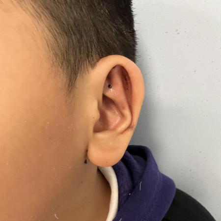 After image 3 Case #129846 - Ear Reshaping