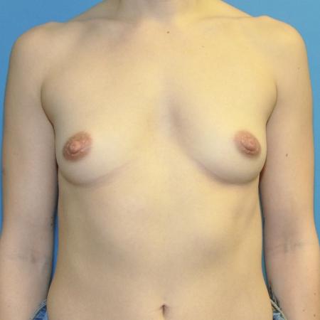 Before image 1 Case #129981 - Breast Augmentation, Motiva, Above the Muscle