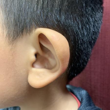 Before image 3 Case #129846 - Ear Reshaping