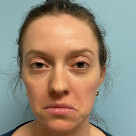 Before image 2 Case #129551 - 31 y.o. female with Botox and Lip Filler