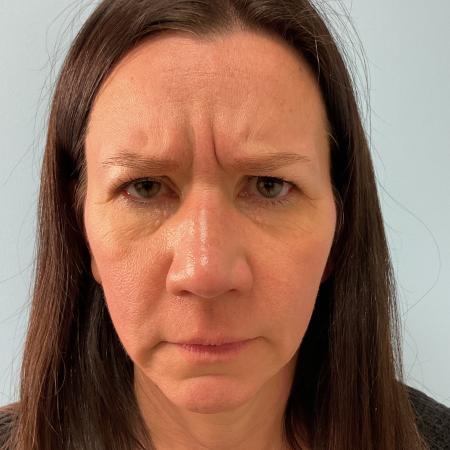 Before image 1 Case #129796 - 45 y.o. female with Botox