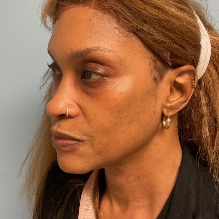 Before image 2 Case #129906 - 54 y.o. female w/ Lower Blepharoplasty