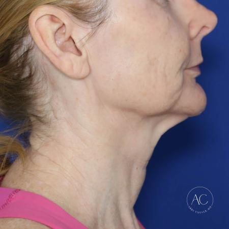 Before image 3 Case #130666 - Face and neck lift