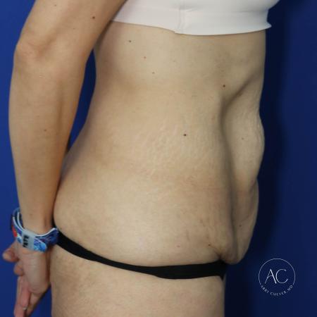 Before image 3 Case #130651 - Extended abdominoplasty after weight loss
