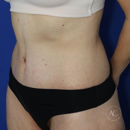 After image 2 Case #130651 - Extended abdominoplasty after weight loss