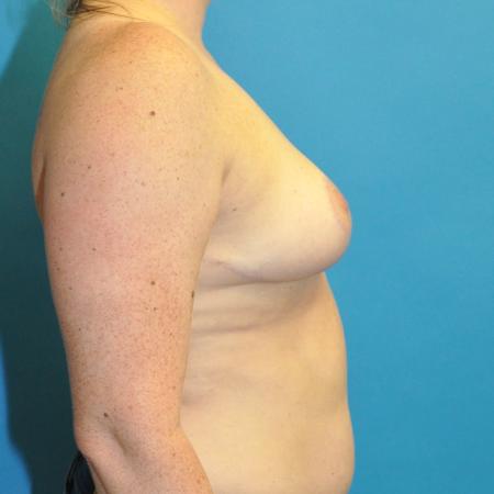 After image 3 Case #130281 - Breast Reduction and Bra Roll Liposuction