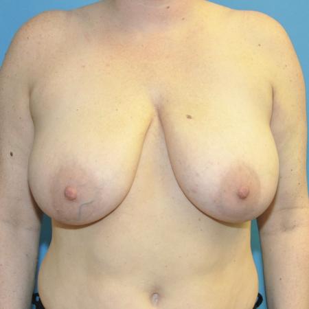 Before image 1 Case #130281 - Breast Reduction and Bra Roll Liposuction