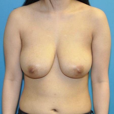 Before image 1 Case #130296 - Breast Reduction