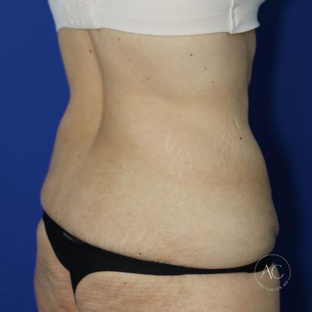 Before image 4 Case #130651 - Extended abdominoplasty after weight loss