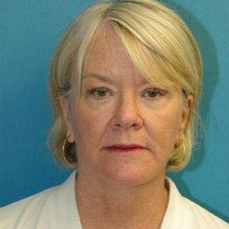 After image 1 Case #130336 - Face and Necklift
