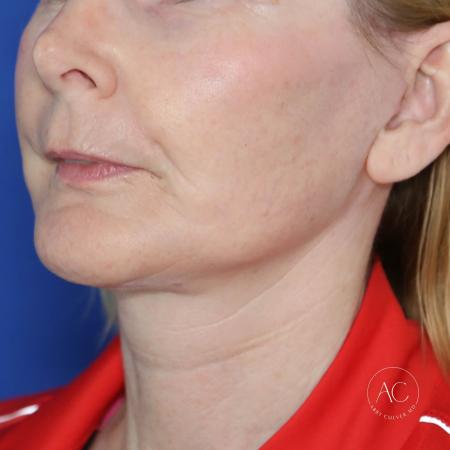After image 2 Case #130666 - Face and neck lift